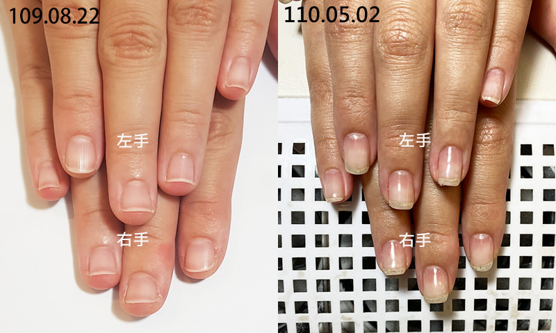 Read more about the article 【指甲矯正】樂意思Lois Nails｜扇形甲一年矯正心得