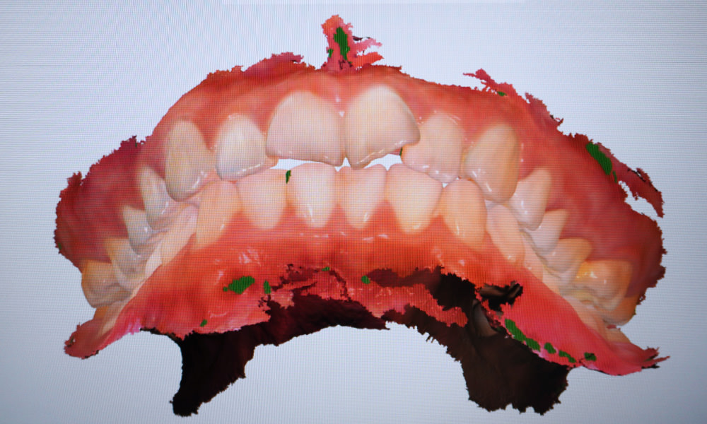 牙齒3D圖